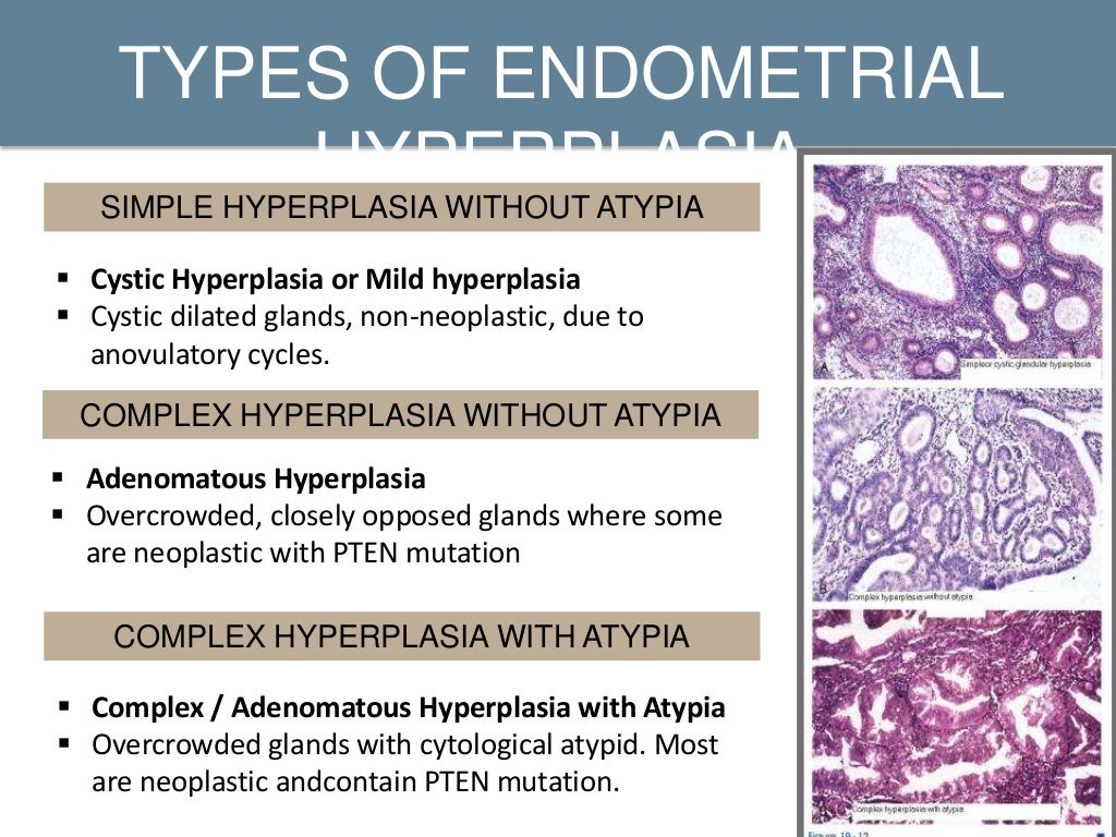 Endometrial Hyperplasia Endometrial Hyperplasia Natur vrogue.co