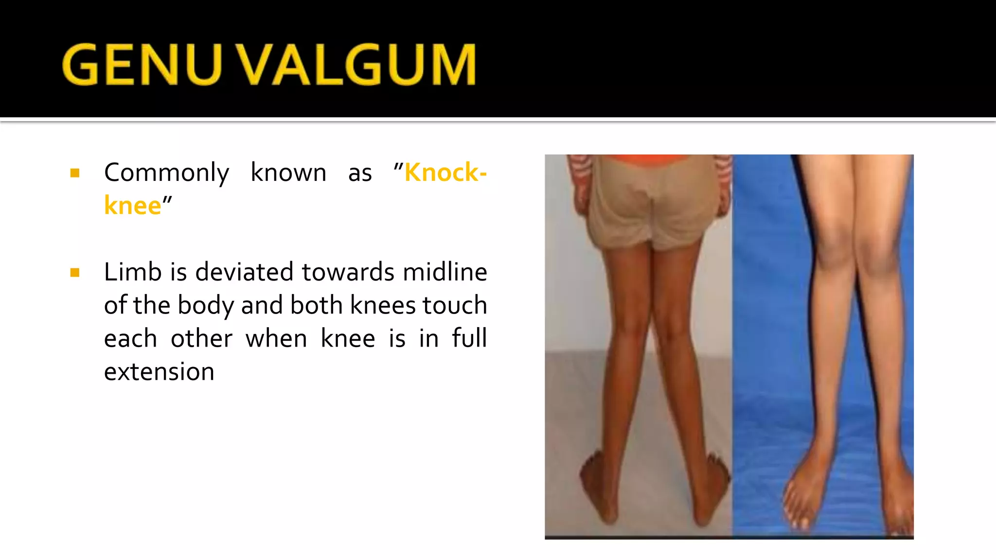  Commonly known as ”Knock-
knee”
 Limb is deviated towards midline
of the body and both knees touch
each other when knee is in full
extension
 