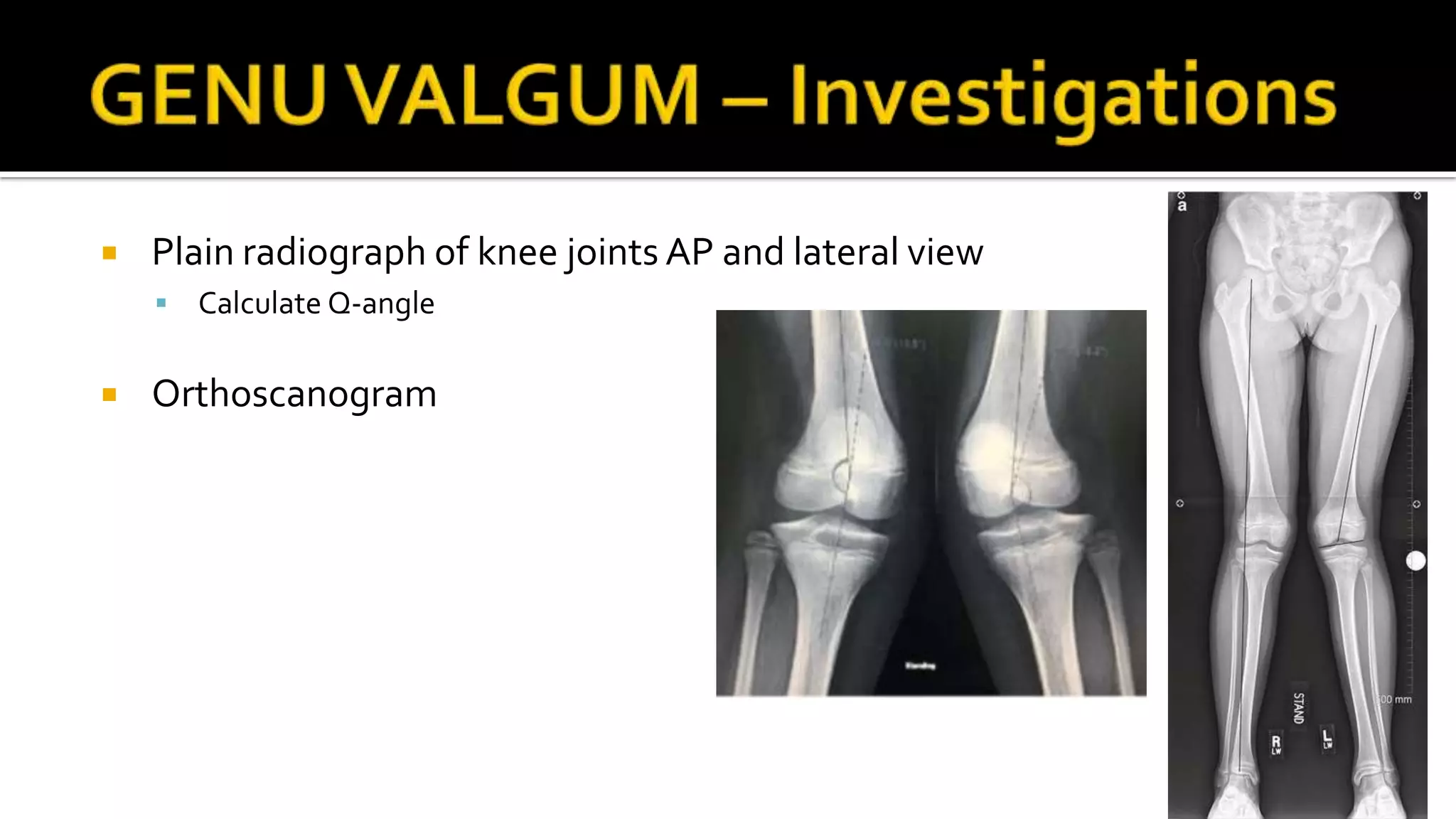  Plain radiograph of knee joints AP and lateral view
 Calculate Q-angle
 Orthoscanogram
 