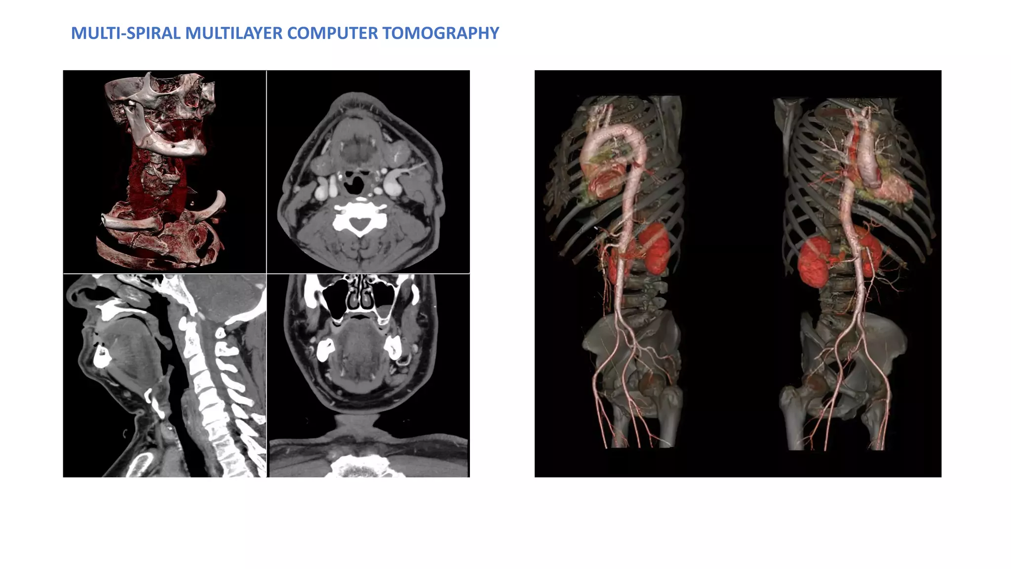MULTI-SPIRAL MULTILAYER COMPUTER TOMOGRAPHY​
 