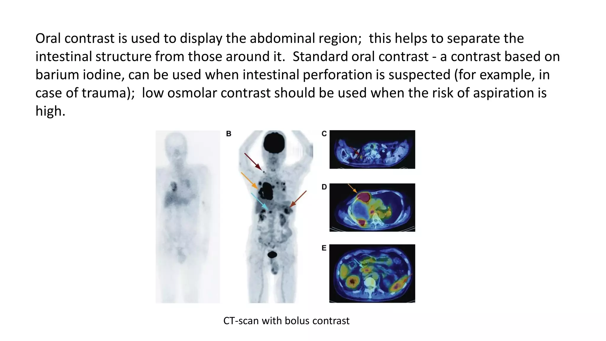 Oral contrast is used to display the abdominal region; this helps to separate the
intestinal structure from those around it. Standard oral contrast - a contrast based on
barium iodine, can be used when intestinal perforation is suspected (for example, in
case of trauma); low osmolar contrast should be used when the risk of aspiration is
high.
CT-scan with bolus contrast
 