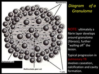 Diagram of a
Granuloma
NOTE: ultimately a
fibrin layer develops
around granuloma
(fibrosis), further
“walling off” the
lesion.
Typical progression in
pulmonary TB
involves caseation,
calcification and cavity
formation.
 
