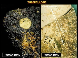 Large caseating tubercle Miliary tubercles
HUMAN LUNG HUMAN LUNG
TUBERCULOSIS
 