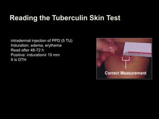 Reading the Tuberculin Skin Test
intradermal injection of PPD (5 TU)
Induration, edema, erythema
Read after 48-72 h
Positive: induration≥ 10 mm
It is DTH
 
