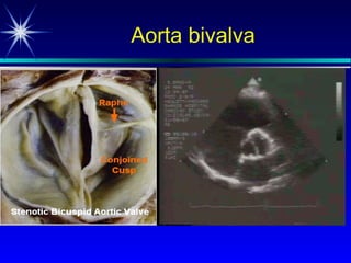 Aorta bivalva 