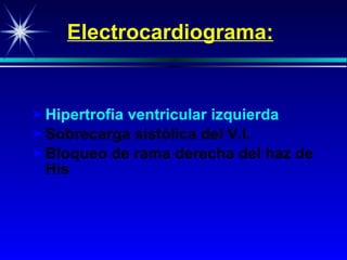 Electrocardiogram a : Hipertrofia ventricular izquierda Sobrecarga sistólica del V.I. Bloqueo de rama derecha del haz de His 