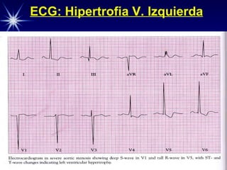 ECG: Hipertrofia V. Izquierda 