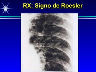 RX: Signo de Roesler 