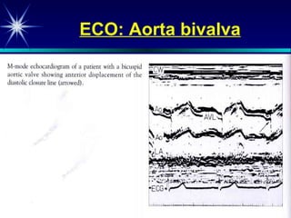 ECO: Aorta bivalva 