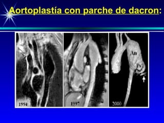 Aortoplastía con parche de dacron : 