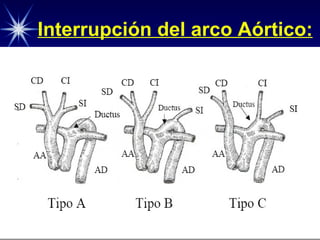 Interrupción del arco Aórtico: 