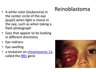 Pupil Mutations 20-eye-diseases.ppt diseae\ses of the eye | PPTX