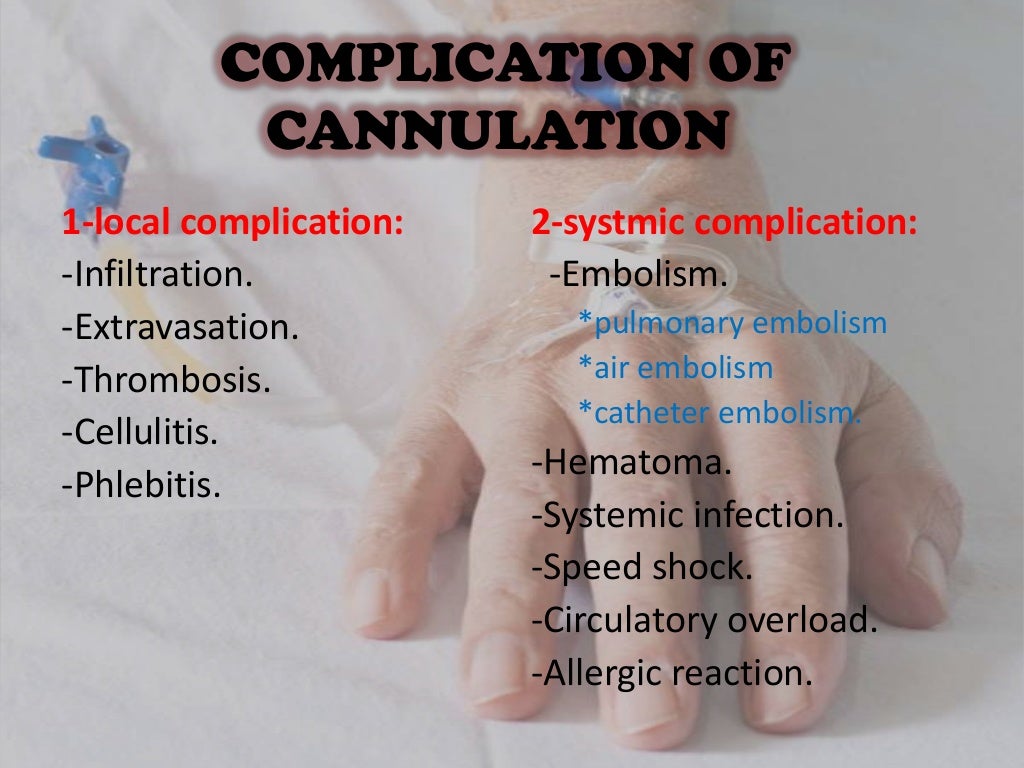 20 iv cannulation
