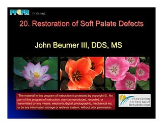 20. Restoration of Soft Palate Defects

             John Beumer III, DDS, MS




*The material in this program of instruction is protected by copyright ©. No
part of this program of instruction may be reproduced, recorded, or
transmitted by any means, electronic,digital, photographic, mechanical etc.
or by any information storage or retrieval system, without prior permission.
 