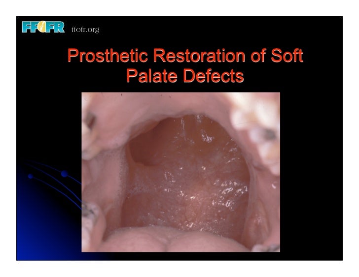20. (new)restoration of soft palate defects