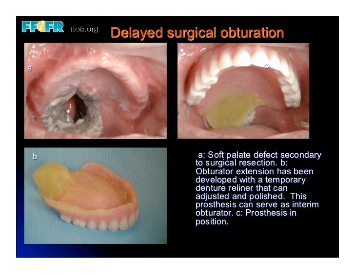 20. (new)restoration of soft palate defects