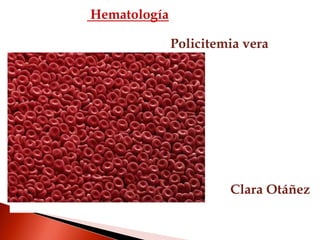 Hematología
Policitemia vera
Clara Otáñez
 