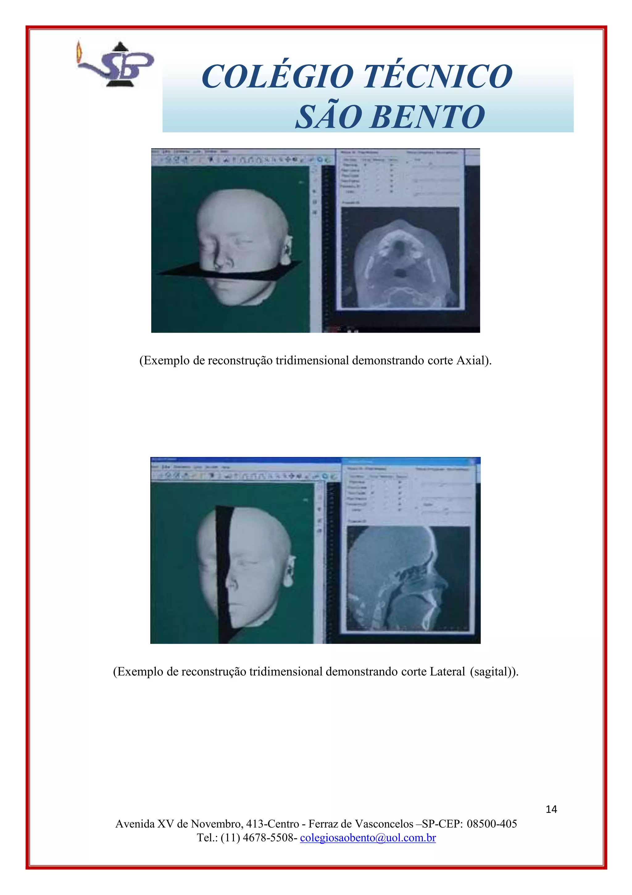 COLÉGIO TÉCNICO
SÃO BENTO
(Exemplo de reconstrução tridimensional demonstrando corte Axial).
(Exemplo de reconstrução tridimensional demonstrando corte Lateral (sagital)).
14
Avenida XV de Novembro, 413-Centro - Ferraz de Vasconcelos –SP-CEP: 08500-405
Tel.: (11) 4678-5508- colegiosaobento@uol.com.br
 