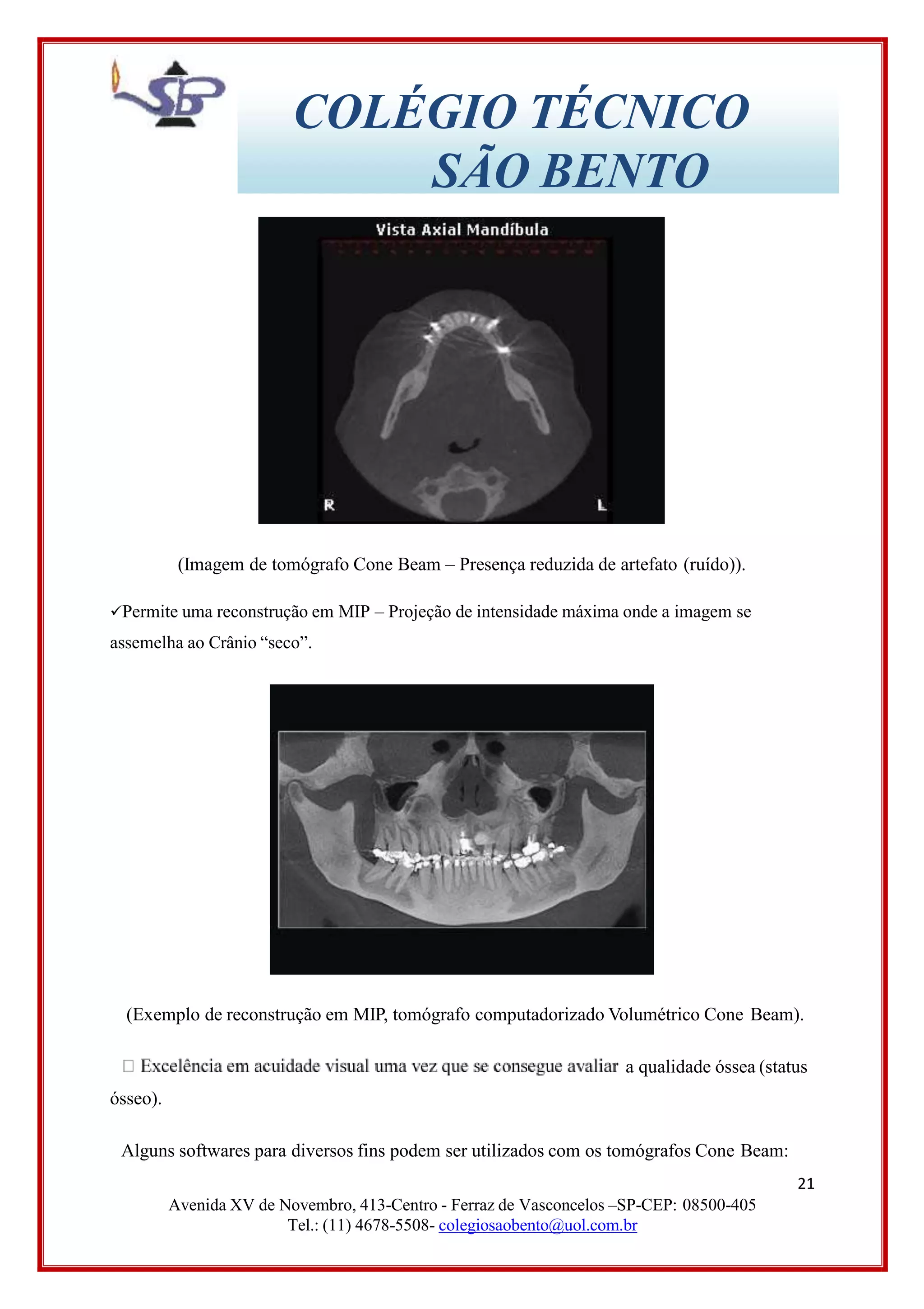 COLÉGIO TÉCNICO
SÃO BENTO
(Imagem de tomógrafo Cone Beam – Presença reduzida de artefato (ruído)).
Permite uma reconstrução em MIP – Projeção de intensidade máxima onde a imagem se
assemelha ao Crânio “seco”.
(Exemplo de reconstrução em MIP, tomógrafo computadorizado Volumétrico Cone Beam).
a qualidade óssea (status
ósseo).
Alguns softwares para diversos fins podem ser utilizados com os tomógrafos Cone Beam:
21
Avenida XV de Novembro, 413-Centro - Ferraz de Vasconcelos –SP-CEP: 08500-405
Tel.: (11) 4678-5508- colegiosaobento@uol.com.br
 