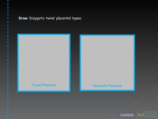 Fused Placenta Separate Placenta Draw : Dizygotic twins ’  placental types. NEXT BACK CONTENTS 