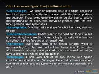 Other less-common types of conjoined twins include: Cephalopagus :  Two faces on opposite sides of a single, conjoined head; the upper portion of the body is fused while the bottom portions are separate. These twins generally cannot survive due to severe malformations of the brain. Also known as janiceps (after the two-faced god Janus) or syncephalus. Synecephalus :  One head with a single face but four ears, and two bodies. Cephalothoracopagus :  Bodies fused in the head and thorax. In this type of twins, there are two faces facing in opposite directions, or sometimes a single face and an enlarged skull. Xiphopagus :  Two bodies fused in the xiphoid cartilage, which is approximately from the navel to the lower breastbone. These twins almost never share any vital organs, with the exception of the liver. A famous example is Chang and Eng Bunker. Ischiopagus :  Fused lower half of the two bodies, with spines conjoined end-to-end at a 180° angle. These twins have four arms; two, three or four legs; and typically one external set of genitalia and anus. NEXT BACK CONTENTS 