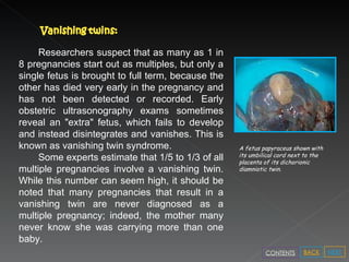 A fetus papyraceus shown with its umbilical cord next to the placenta of its dichorionic diamniotic twin. Researchers suspect that as many as 1 in 8 pregnancies start out as multiples, but only a single fetus is brought to full term, because the other has died very early in the pregnancy and has not been detected or recorded. Early obstetric ultrasonography exams sometimes reveal an "extra" fetus, which fails to develop and instead disintegrates and vanishes. This is known as vanishing twin syndrome.   Some experts estimate that 1/5 to 1/3 of all multiple pregnancies involve a vanishing twin. While this number can seem high, it should be noted that many pregnancies that result in a vanishing twin are never diagnosed as a multiple pregnancy; indeed, the mother many never know she was carrying more than one baby. NEXT BACK CONTENTS 