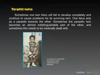 A picture of a child with his parasitic twin connected in his abdomen Sometimes one twin fetus will fail to develop completely and continue to cause problems for its surviving twin. One fetus acts as a parasite towards the other. Sometimes the parasitic twin becomes an almost indistinguishable part of the other, and sometimes this needs to be medically dealt with. NEXT BACK CONTENTS 