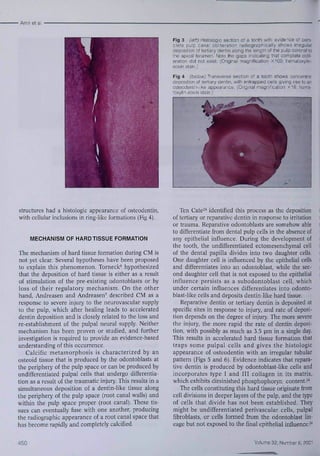 • Amir et al 
Fig 3 (left) Histologie section of a tooth vMi evidence ot com-plete 
pulp canal obliteration radiographically shows irregular 
deposition ot te'tiary dentin along the length of tne pulp coronal to 
tne apical foramen. Note tne gaps indicating tnat compiete oblit-eration 
did not exist (Original magnification xlOO, hematcxylin-eosin 
stain.) 
Fig 4 (below) Transverse section cf a tootfi shows concentric 
deposition of tertiary dentin. with entrapped ceils giving rise to an 
cstecdentirt-iii<e appearance. [Originai rnagnification '16: lierra-ic/ 
ylin-eosin stain.^ 
structures had a histologie appearance of osteodentin, 
with celiular inclusions in ring-like formations (Fig 4). 
MECHANISM OF HARDTISSUE FORMATION 
The mechanism of hard tissue formation during CM is 
not yet clear. Several hypotheses have been proposed 
to explain this phenomenon, Torneck* hypothesized 
that the deposition of hard tissue is either as a resiilt 
of stimulation of the pre-existing odontohlasts or by 
loss of their regulatory mechanism. On the other 
hand, Andreasen and Andreasen' described CM as a 
response to severe injury to the neurovasciilar supply 
to the pulp, which after healing leads to accelerated 
dentin deposition and is closely related to the loss and 
re-establishmcnt of the pulpal neural supply. Neither 
mechanism has been proven or studied, and further 
investigation is required to provide an evidence-based 
understanding of this occurrence, 
Calcific metamorphosis is characterized by an 
osteoid tissue that is produced by the odontoblasts at 
the periphery of the pulp space or can be produced by 
undifferentiated puipai cells that undergo differentia-tion 
as a result of the traumatic injury. This results in a 
simultaneous deposition of a dentin-like tissue along 
the periphery of the pulp space (root canal walls) and 
within the pulp space proper (root canal). These tis-sues 
can eventually fuse with one another, producing 
the radiographie appearance of a root canal space that 
has become rapidly and completely calcified. 
Ten Cate''* identified this process as the deposition 
of tertiary or reparative dentin in response to irritation 
or trauma. Reparative odontoblasts are somehow able 
to differentiate from dental pulp cells in the absence of 
any epithelial influence. During the development of 
the tooth, the undifferentiated ectomesenehymal cell 
of the dental papilla divides into two daughter cells. 
One daughter cell is influenced by the epithelial cells 
and differentiates into an odontoblast, while the sec-ond 
daughter cell that is not exposed to the epithelial 
influence persists as a subodontoblast cell, which 
under certain influences differentiates into odonto-biast- 
like cells and deposits dentin-like hard tissue. 
Reparative dentin or tertiary dentin is deposited at 
specific sites in response to injury, and rate of deposi-tion 
depends on the degree of injury. The more severe 
the injury, the more rapid the rate of dentin deposi-tion, 
with possibly as much as 3,5 jjm in a single day. 
This results in accelerated hard tissue formation that 
traps some pulpal cells and gives the histologie 
appearance of osteodentin with an irreguiar tubular 
pattern {Figs 5 and 6), Evidence indicates that repara-tive 
dentin is produced by odontoblast-like cells and 
incorporates type I and III collagen in its matrix, 
which exhibits diminished phosphophoryn content."* 
The cells constituting this hard tissue originate from 
cell divisions in deeper layers of the pulp, and the type 
of cells that divide has not been established. They 
might be undifferentiated perivascular cells, pulpal 
fibroblasts, or cells formed from the odontohlast lin-eage 
but not exposed to the final epithelial influence.^* 
450 Volume 32, Numbet 6, 2001 
 