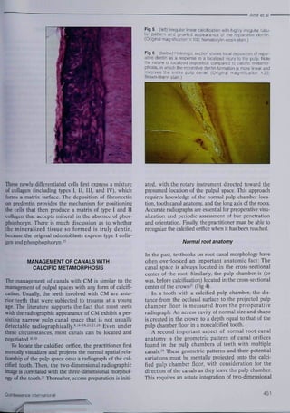 Fig 5 (ieñ) Irregular linear caloilication with highly irregular tubu-lar 
pattern and gnarled appearance oí the reparative dentin. 
{Originai magnilioation x100, hematoxyhn-eosin stain.] 
Fig 6 (beiow) Histoiogic seotior shows locai aeposition ol repar-ative 
dentin as a response lo a localized injury lo the pulp Note 
the naiufe ot localized deposition compared to calcilic metamor-phosis, 
in which (he reparative dentin tormation is more linear and 
invoives the entire pulp canal. (Original magnification x25: 
Brown-Brenn stain.) 
These newly differentiated cells first express a mixture 
of collagen (including types J, II, 111, and IV), which 
forms a matrix surface. The deposition of fibronectin 
on predentin provides the mechanism for positioning 
the cells that then produce a matrix of type I and II 
collagen that accepts mineral in the absence of phos-phophoryn. 
There is much discussion as to whether 
the mineralized tissue so formed is truly dentin, 
because the original odontoblasts express type I colla-gen 
and phosphophoryn,'^ 
MANAGEMENT OF CANALS WITH 
CALCIFIC METAMORPHOSIS 
The management of canals with CM is similar to the 
management of pulpal spaces with any form of calcifi-cation. 
Usually, the teeth involved with CM are ante-rior 
teeth that were subjected to trauma at a young 
age. The literature supports the fact that most teeth 
with the radiographie appearance of CM exhibit a per-sisting 
narrow pulp canal space that is not usually 
detectable radiographicaliy.^'''-'^'^'''^''^^ Even under 
these circumstances, most canals can be located and 
negotiated.'•"a 
To locate the calcified orifice, the practitioner first 
mentally visualizes and projects the normal spatial rela-tionship 
of the pulp space onto a radiograph of the cal-cified 
tooth. Then, the two-dimensional radiographie 
image is correlated with the three-dimensional morphol-ogy 
of the tooth.^ Thereafter, access preparation is initi-ated, 
with the rotary instrument directed toward the 
presumed location of the pulpal space. This approach 
requires knowledge of the normal pulp chamher loca-tion, 
tooth canal anatomy, and the long axis of the roots. 
Accurate radiographs are essential for preoperative visu-alization 
and periodic assessment of bur penetration 
and orientation. Finally, the practitioner must be able to 
recognize the calcified orifice when it has been reached. 
Normal root anatomy 
In the past, textbooks on root canal morpbology have 
often overlooked an important anatomic fact: The 
canal space is always located in tbe cross-sectional 
center of the root. Similarly, the pulp chamber is (or 
was, before calcification) located in the cross-sectional 
center of the crown^' (Fig 4). 
In a tooth with a calcified pulp chamber, the dis-tance 
from the occlusal surface to the projected pulp 
chamber floor is measured from the preoperative 
radiograph. An access cavity of normal size and shape 
is created in the crown to a depth equal to that of the 
pulp chamber floor in a noncalcified tooth. 
A second important aspect of normal root canal 
anatomy is the geometric pattern of canal orifices 
found in the pulp chambers of teeth with multiple 
canals.^*" These geometric patterns and their potential 
variations must be mentally projected onto the calci-fied 
pulp chamber floor, with consideration for tbe 
direction of the canals as they leave the pulp chamber. 
This requires an astute integration of two-dimensional 
Quintessence Inlernationai 451 
 