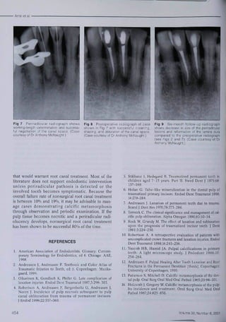• Amir ef al 
Fig 7 Per,radicular radiograph shows 
woikihg-length determination and success-ful 
negotiation of Ihe canal space. (Case 
courtesy of Dr Anthony McNaught.) 
Fig 8 Postoperaiive raoiograph of case 
shown in Fig 7 with successful cleaning, 
shaping, and obiuration of the canal space. 
(Case courlesy of Dr Anthony McNaught.) 
Fig 9 Six-month iollow-up radiograph 
shows decrease in size of Ihe periradicular 
lesions and reformation of the lamina dura 
compared to the preoperative radicgraph 
(see Figs 2 and 7). (Case courfesy ot Dr 
Anthony McNaughf.) 
that would warrant root canal treatment. Most of the 
literature does not support endodontic intervention 
unless periradicular pathosis is detected or the 
involved tooth becomes symptomatic. Because the 
overall failure rate of nonsurgical root canal treatmetit 
is between 10% and 19%, it may be advisable to man-age 
cases demonstrating calcific metamorphosis 
through ohservation and periodic examination. If the 
pulp tissue becomes necrotic and a periradicular radi-oiucency 
develops, nonsurgical root canal treatment 
has been shown to be successful 80% of the time. 
REFERENCES 
1, American Association of Endodontisls, Glossary; Contem-porary 
Terminology for Endodontics, ed 6. Chicago: AAE, 
1998, 
2, Andreasen J, Andrcasen F. Textbook and Color Atlas of 
Traumatic Injuries to Teeth, ed 3, Copenhagen: Munks-gaard, 
1994. 
3, Oikarinen K, Gundlach K, Pfeifer G, Late complication of 
luxation injuries, Endod Dent Traumatol 1987;5:2f)6-303, 
4, Robertson A, Andreasen F, Bergenholtz G, Andreasen J, 
Noren J Incidence of pulp necrosis subsequent to pulp 
canal obliteration from trauma of permanent incisors. 
J Endod 1996:22:557-560, 
5. Stâlhane 1, Hedegard B, Traumatized permanent teeth in 
children aged 7-15 years. Part II, Swed Dent J 1975;68: 
157-169. 
6. Holan G. Tube-hke mineralization in the dental pulp ot 
traumatized primary incisors, Endod Dent Traumatol 1998; 
14:279-284. 
7. Andreasen J, Luxation of permanent teeth due to trauma. 
Scand J Dent Res 1970;78:273-286, 
8. TOI neck C. The clinical significance and management of cal-cific 
pulp obliteration. Alpha Omegan 1990;83:50-54, 
9. Rock W, Grundy M. The effect of luxation and subluxafion 
upon the prognosis of traumatized incisor teeth. J Dent 
1981;3:224-230, 
10, Robertson A, A retrospective evaluation of patients with 
uncomplicated erown fractures and luxation injuries, Endod 
Dent Traumatol 1998; 14:245-256, 
11, Yaacob HB, Hamid JA. Pulpal calcifications in primary 
teeth: A light microscope study, J Pedodont 1986;10: 
254-264, 
12, Andreasen K Pulpal Healing After Tooth Luxation and Root 
Fractures in the Permanent Dentition [thesis]. Copenhagen: 
University of Copenhagen, 1995, 
13, Patterson S, Mitchell D, Calcific metamorphosis of the den-tal 
pulp. Oral Surg Oral Med Oral Pathol 1965:20:94-101, 
14, Holcomb J, Gregory W, Calcific metamorphosis of the pulp: 
Its incidence and treatment. Oral Surg Oral Med Oral 
Pathol 1967:24:825-830, 
454 Volume 32, Number 6, 2001 
 