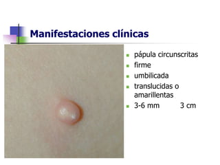 Manifestaciones clínicas
 pápula circunscritas
 firme
 umbilicada
 translucidas o
amarillentas
 3-6 mm 3 cm
 