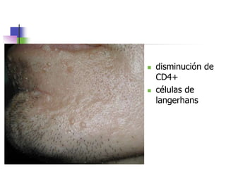  disminución de
CD4+
 células de
langerhans
 