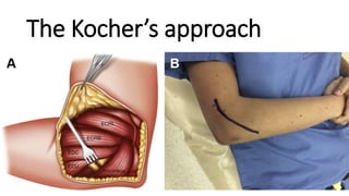 The Kocher’s approach
 