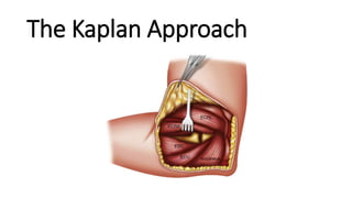 The Kaplan Approach
 