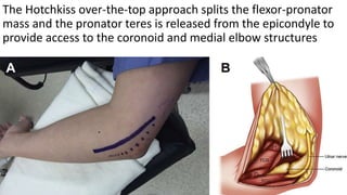 The Hotchkiss over-the-top approach splits the flexor-pronator
mass and the pronator teres is released from the epicondyle to
provide access to the coronoid and medial elbow structures
 