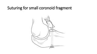 Suturing for small coronoid fragment
 