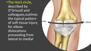 •The Horii circle,
described by
O’Driscoll and
colleagues,outlines
the typical pattern
of soft tissue injury
for elbow
dislocations
proceeding from
lateral to medial
 