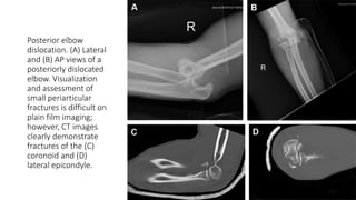Posterior elbow
dislocation. (A) Lateral
and (B) AP views of a
posteriorly dislocated
elbow. Visualization
and assessment of
small periarticular
fractures is difficult on
plain film imaging;
however, CT images
clearly demonstrate
fractures of the (C)
coronoid and (D)
lateral epicondyle.
 