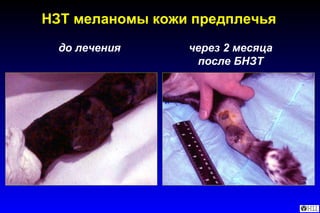 НЗТ меланомы кожи предплечья до лечения через 2 месяца после БНЗТ 