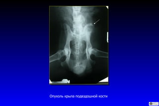 Опухоль крыла подвздошной кости 
