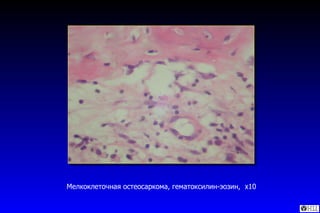 Мелкоклеточная остеосаркома, гематоксилин-эозин,  х10 