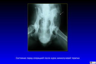 Состояние перед операцией после курса химиолучевой терапии 