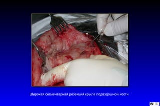 Широкая сегментарная резекция крыла подвздошной кости  
