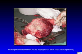 Резецированный фрагмент крыла подвздошной кости (этап скелетирования) 