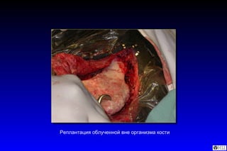 Реплантация облученной вне организма кости  