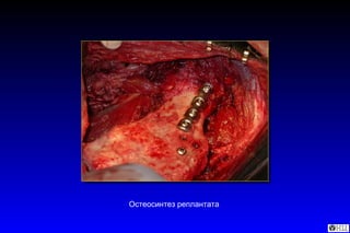Остеосинтез реплантата   