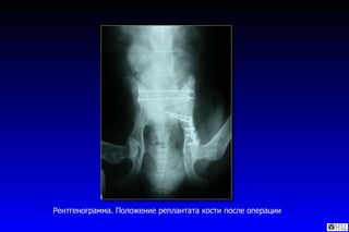 Рентгенограмма. Положение реплантата кости после операции  