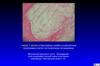 Облученный реплантат кости.  Безъядерные поля опухолевой костной ткани в состоянии некробиоза. Гематоксилин-эозин х 10  через 1 месяц  в биопсийных пробах из реплантата опухолевые клетки гистологически не выявлены   
