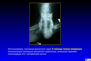 Рентгенограмма. Состояние реплантата через  3 месяца после операции  Анатомическое положение реплантата правильное, начальные признаки консолидации его с материнской костью 