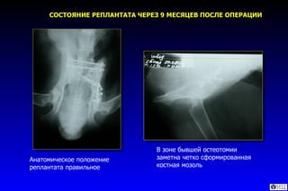 Анатомическое положение реплантата правильное В зоне бывшей остеотомии заметна четко сформированная костная мозоль СОСТОЯНИЕ РЕПЛАНТАТА ЧЕРЕЗ 9 МЕСЯЦЕВ ПОСЛЕ ОПЕРАЦИИ 